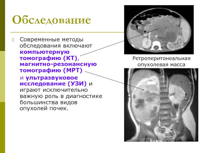 Нейробластома у детей презентация