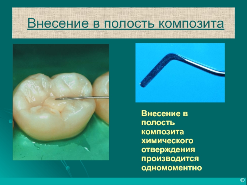 Презентация композиты в стоматологии