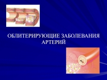 ОБЛИТЕРИРУЮЩИЕ ЗАБОЛЕВАНИЯ АРТЕРИЙ