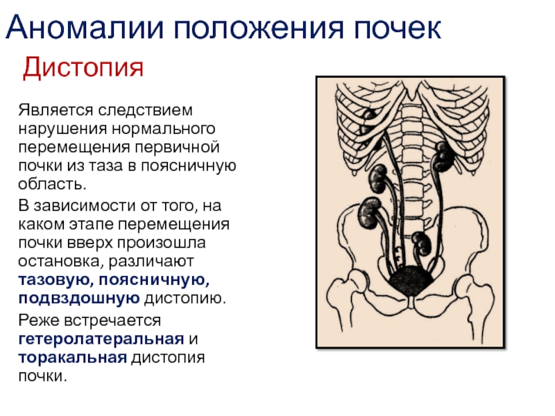 Аномалии таза презентация