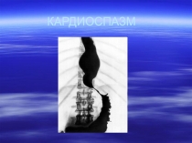 Кардиоспазм