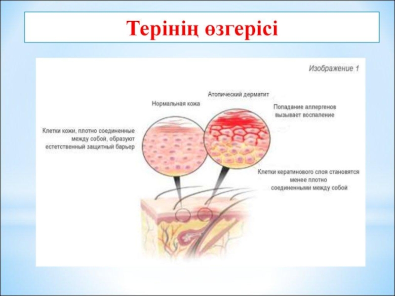 Аллергиялық аурулар презентация