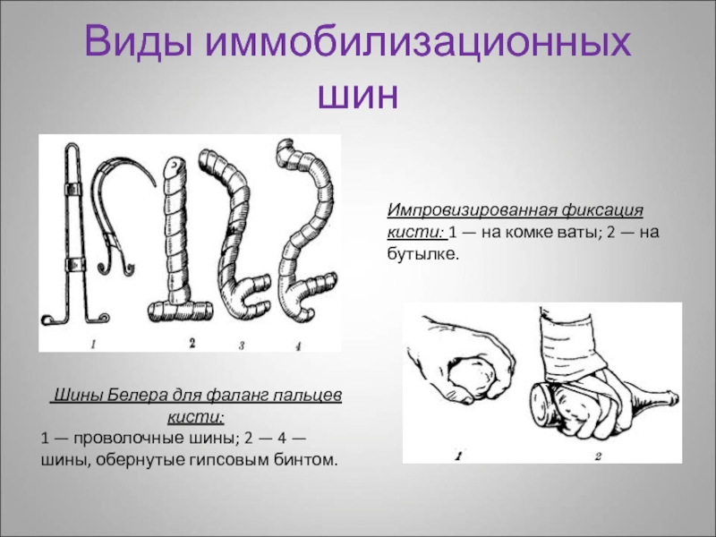 Виды иммобилизационных шин Шины Белера для фаланг пальцев кисти: 1 — проволочные шины; 2 — 4 —