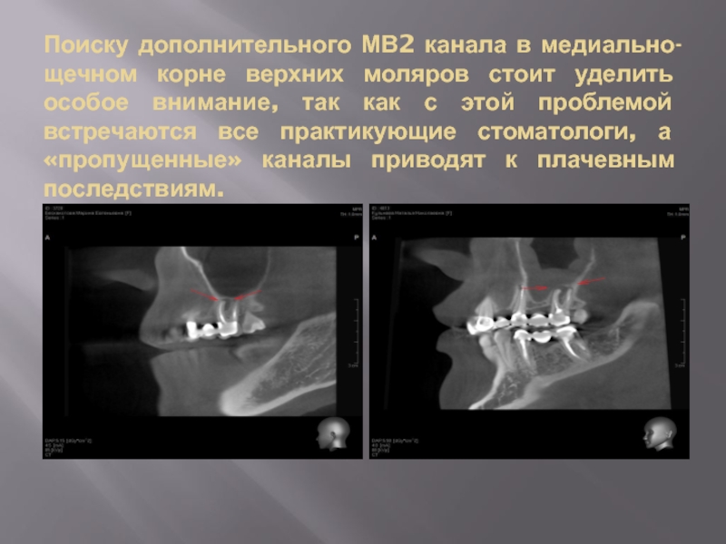 Найди второй канал. Медиально щечный канал зуба. Дистально щечный канал. Медиальный щечный корень.