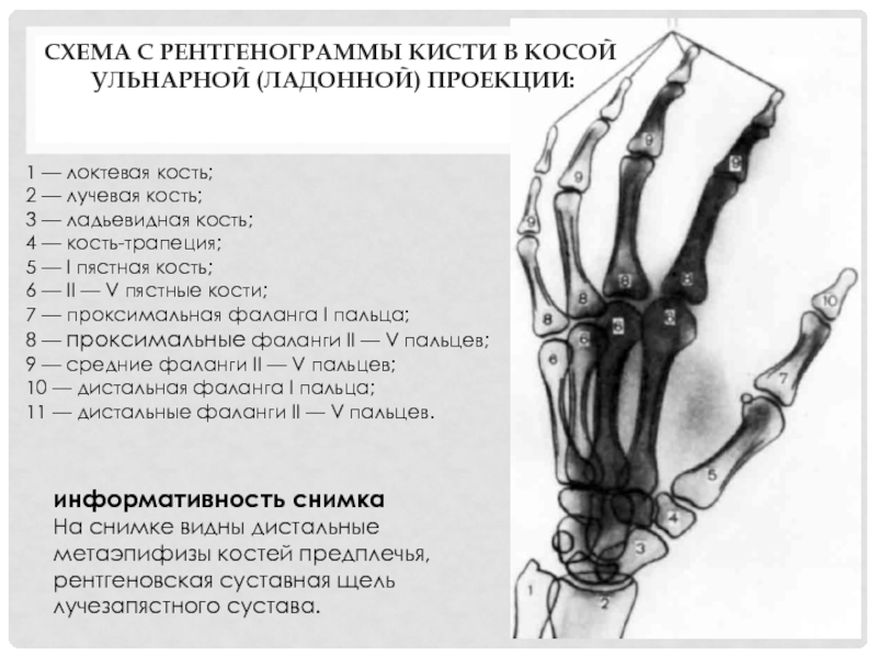 Рассмотрите рентгенограмму с изображением кисти человека как