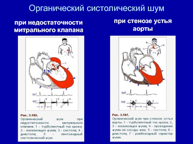 Недостаточность митрального клапана студфайл