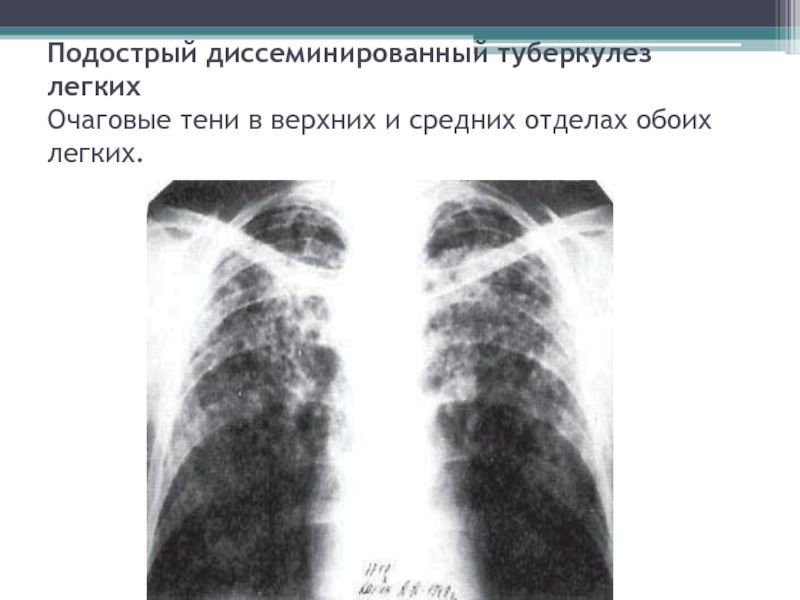 Острый диссеминированный туберкулез. Гематогенно диссеминированный туберкулез рентген. Острый диссеминированный туберкулез рентген. Крупноочаговый диссеминированный туберкулез рентген. Острый диссеминированный туберкулез легких рентген.