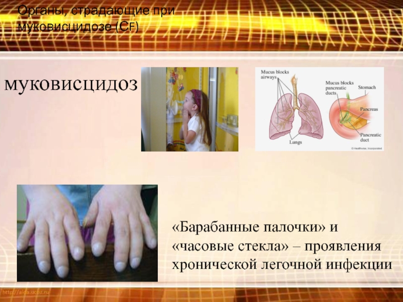 Муковисцидоз частота заболевания. Муковисцидоз легочная форма симптомы. Муковисцидоз презентация.