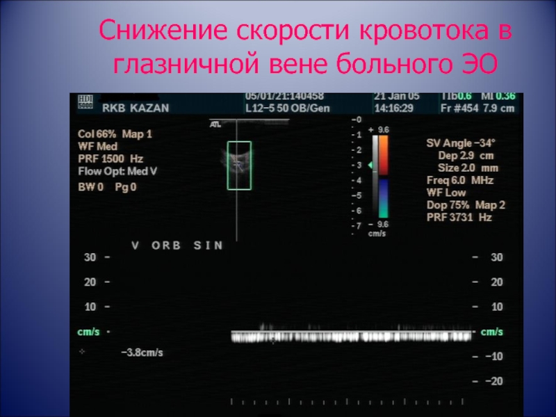 Скорость кровотока в вене