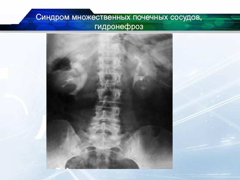 Аномалии почек презентация