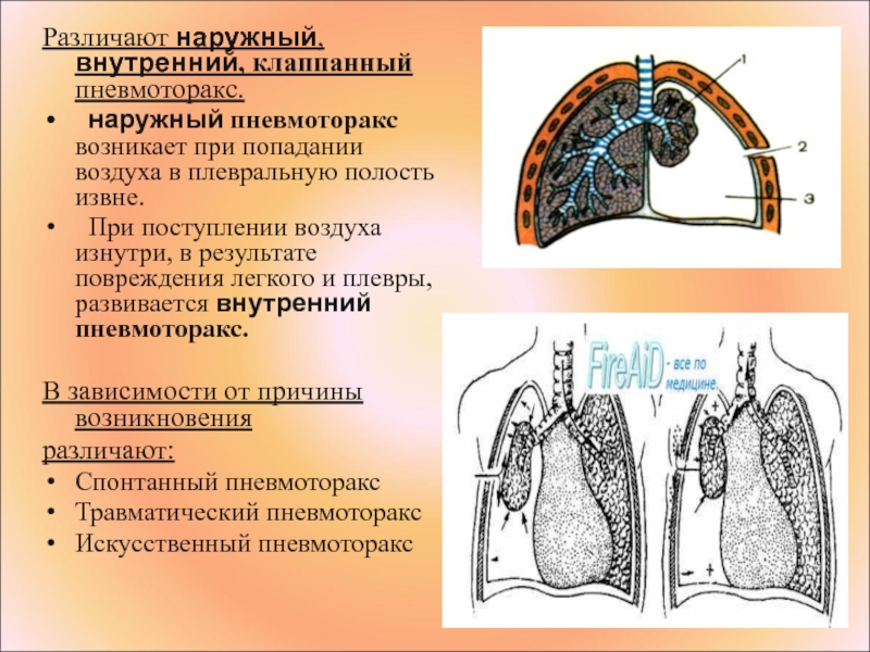 Полость закрывать. Травматический пневмоторакс дренирование. Рецидивный пневмоторакс. Наружный и внутренний пневмоторакс. Клапанный пневмоторакс давление в плевральной полости.