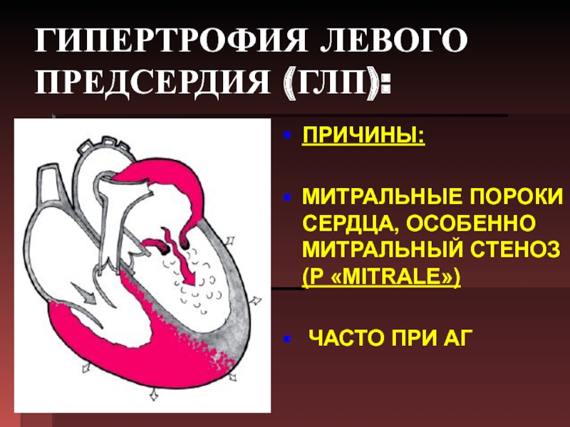 Гипертрофия левого предсердия левого желудочка. Гипертрофия левого предсердия. Гипертрофии отделов сердца при пороках. Гипертрофия левого желудочка и предсердия. Гипертрофия левых отделов сердца.