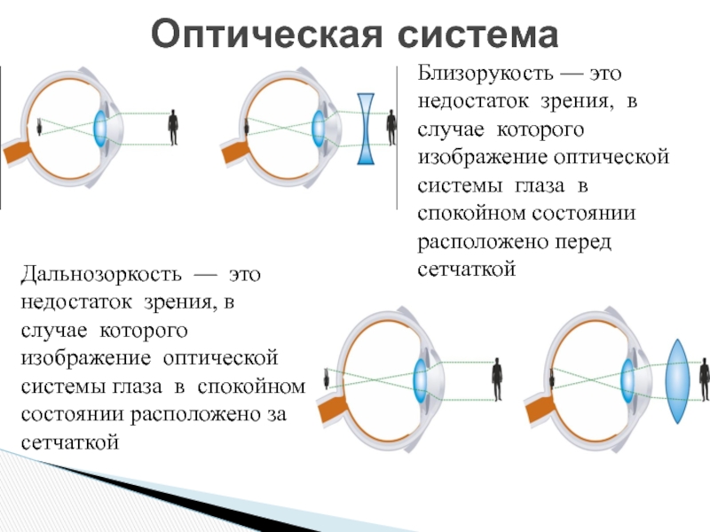 Миша страдает близорукостью а его брат дальнозоркостью. Оптическая система глаза при близорукости и дальнозоркости. Зрительный анализатор дальнозоркость и близорукость. Дальнозоркость глазное яблоко. Оптическая схема глаза с близорукостью и дальнозоркостью.