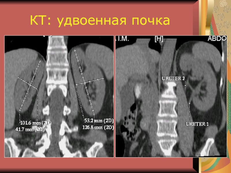 Удвоенная почка у взрослого фото