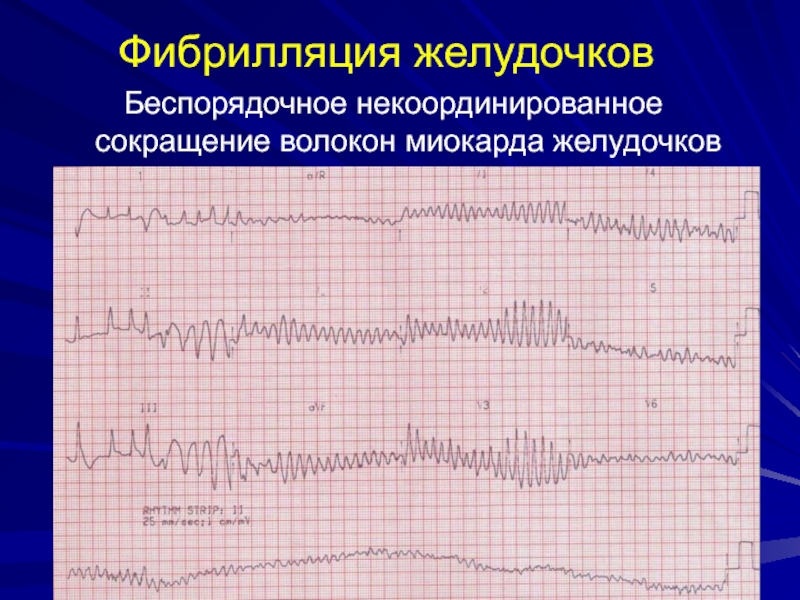 Скорость циркуляторного укорочения волокон миокарда. Скорость циркулярного укорочения волокон миокарда. Скорость циркулярного укорочения волокон миокарда левого.