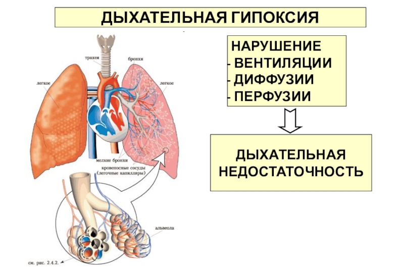 Острая дыхательная недостаточность картинки для презентации