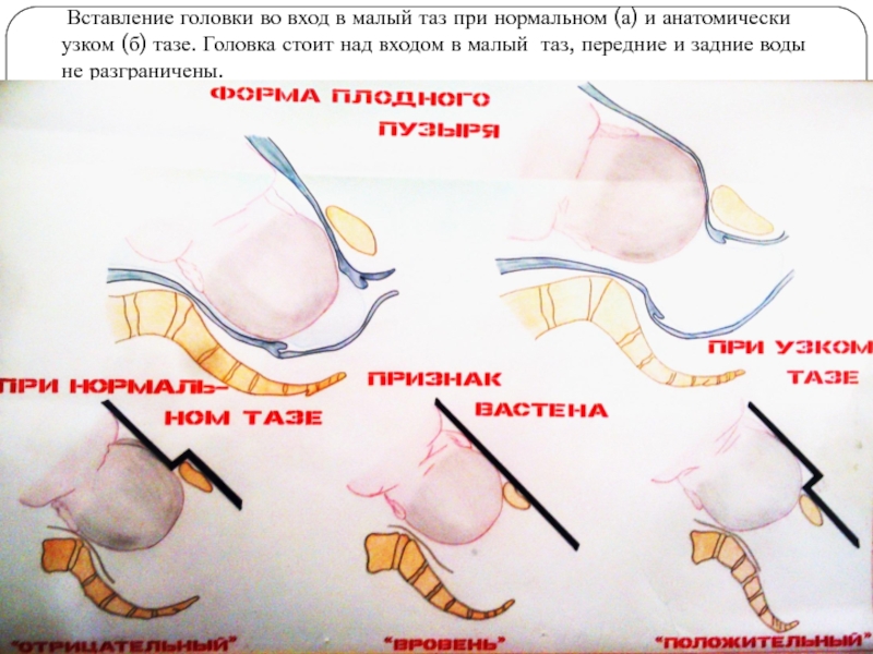 Вставление головки во вход в малый таз при нормальном (а) и анатомически узком (б)