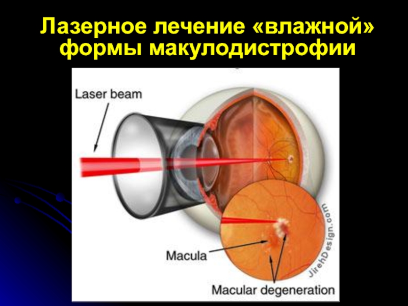 Возрастная макулярная дегенерация презентация