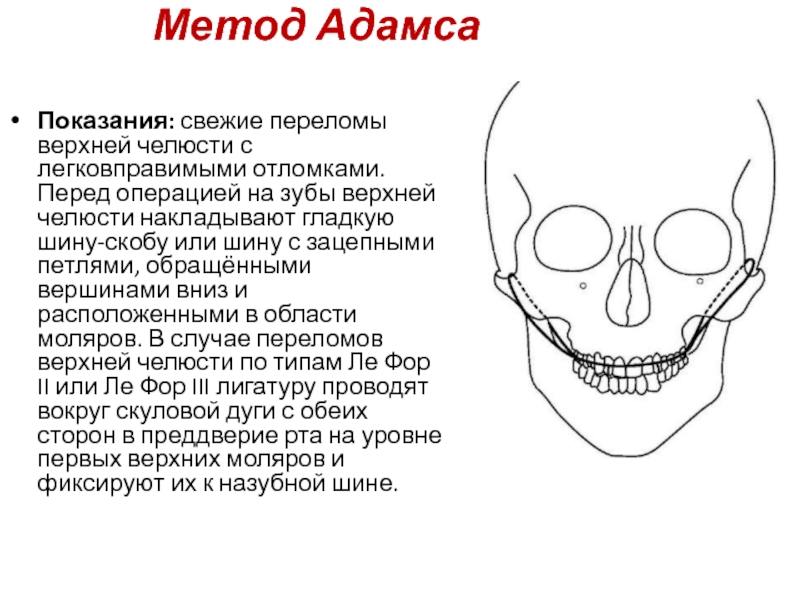 Клиническая картина при переломах нижней челюсти