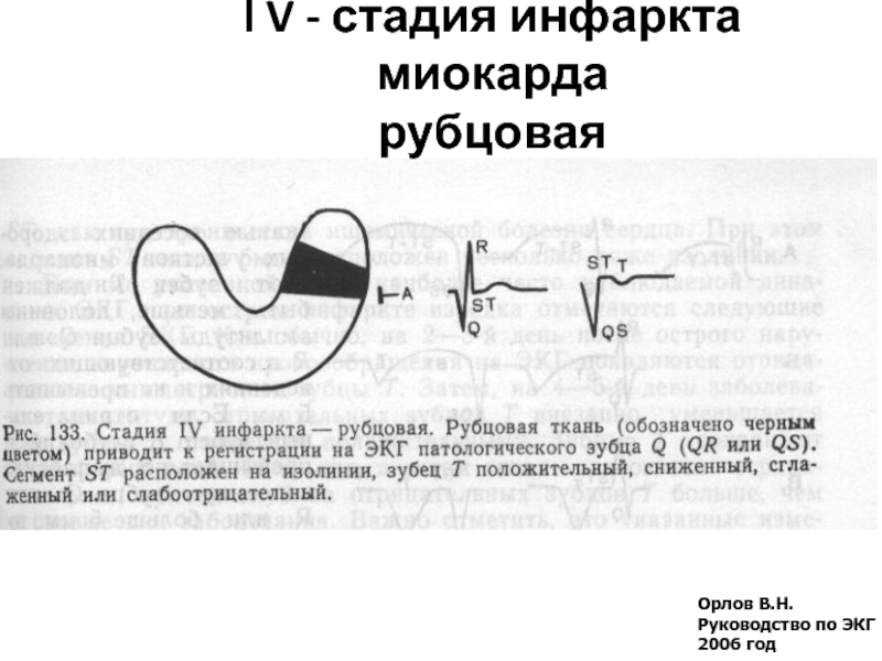 Стадии инфаркта миокарда. Рубец при инфаркте миокарда. Рубец после инфаркта на ЭКГ. Инструментальные методы исследования инфаркта миокарда.