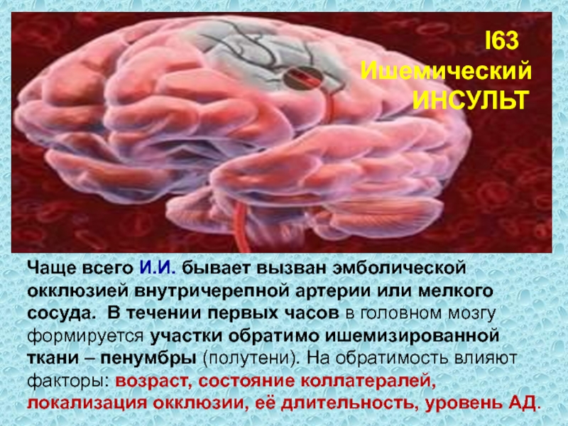 Эмболический инсульт. ОНМК Тиа и инсульт. Эмболический инсульт головного мозга. Инфаркт головного мозга эмболический.