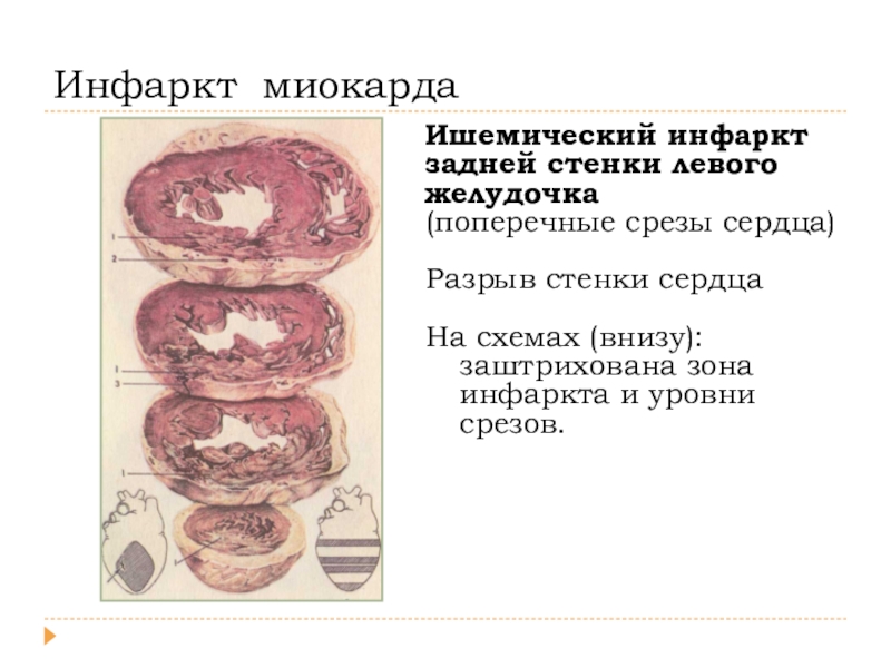 Инфаркт миокарда стенки. Инфаркт миокарда задней стенки. Инфаркт миокарда задней стенки левого желудочка. Инфаркт миокарда по задней стенке левого желудочка. Инфаркт задней стенки сердца.