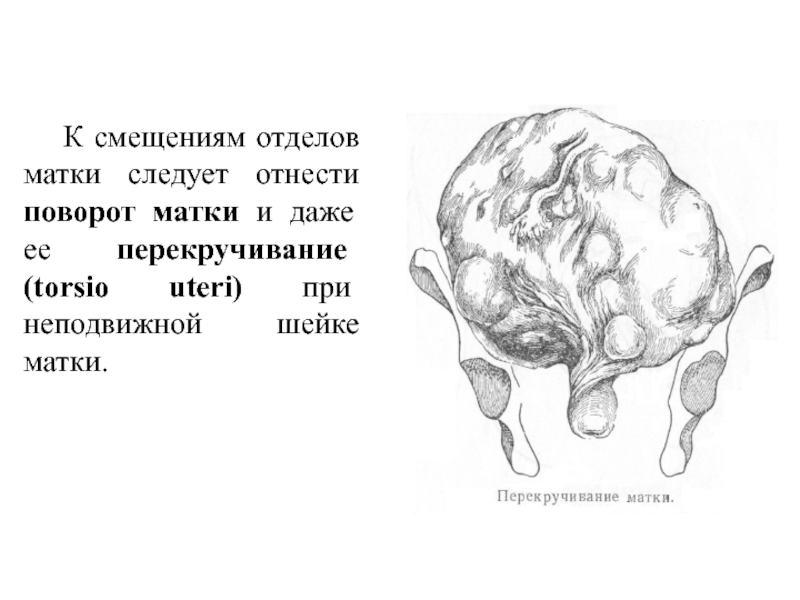 Перекрут придатков матки презентация