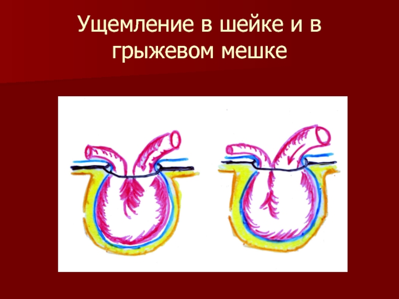 Осложнения грыж. Осложнения грыжевого мешка. Ущемление в грыжевом мешке.