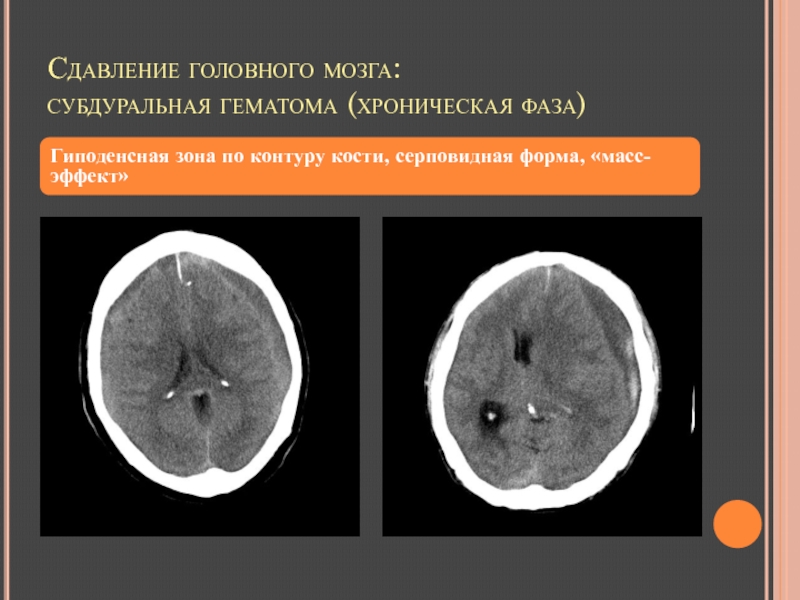 Сдавление головного мозга гематомой. Хроническая субдуральная гематома на кт. Субдуральная гематома головного мозга кт. Субдуральная гематома на кт. Хроническая субдуральная гематома кт протокол.