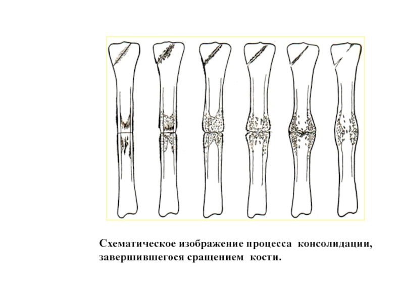 Перелом кости рисунок