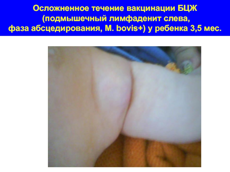 Осложненное течение вакцинации БЦЖ  (подмышечный лимфаденит слева,  фаза абсцедирования, М. bovis+) у ребенка 3,5 мес.