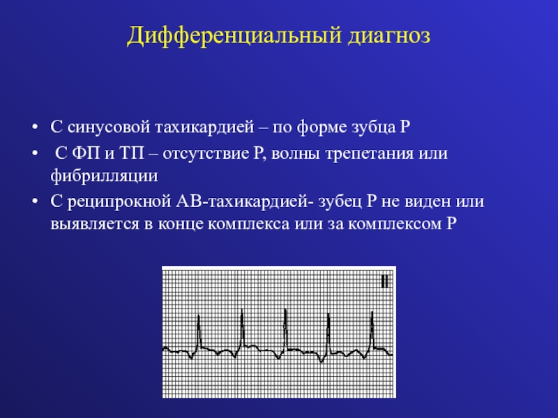 Волны при трепетании предсердий. Волны трепетания предсердий. Волны трепетания и волны фибрилляции. Волны фибрилляции предсердий. Диф диагноз фибрилляция предсердий.