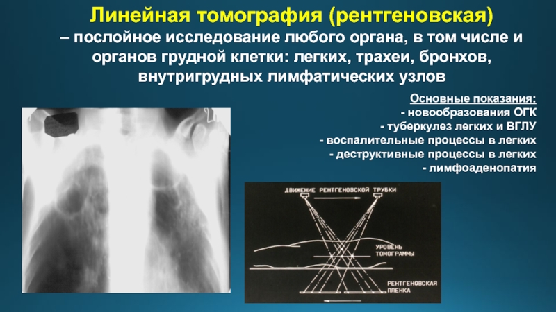 Изменения на компьютерной томографии легких при первичных вирусных пневмониях