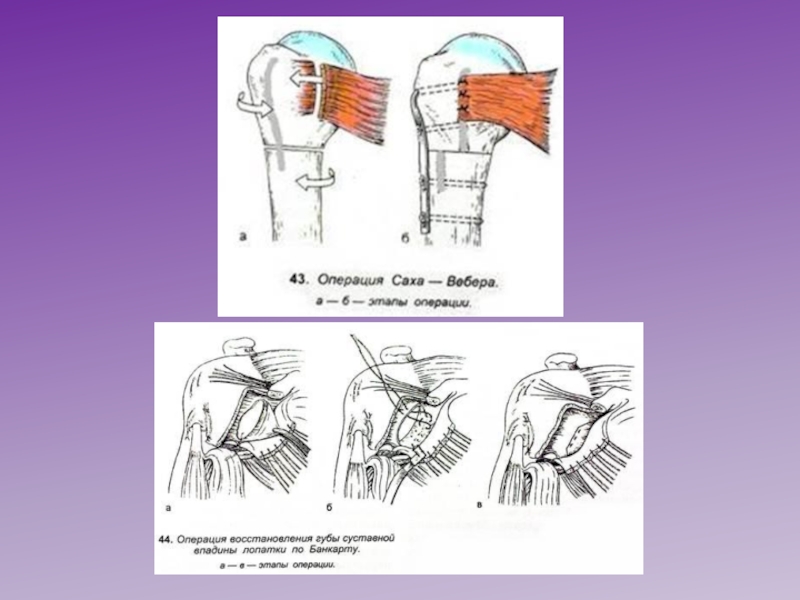 Операция при вывихе плеча