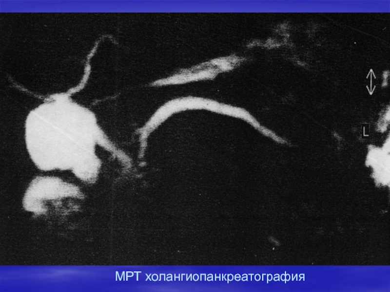 Мрхпг это. МРХПГ поджелудочной железы. Магнитно резонансная холангиопанкреатография МРХПГ. Холангиопанкреатография мрт. Магнитно-резонансная холангиопанкреато- графия (МР-ХПГ).