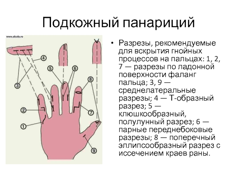 Панариций виды. Разрезы при подкожном панариции. Вскрытие панариция подкожного кисти. Кожаный подкожный панариций. Костный панариций разрезы.