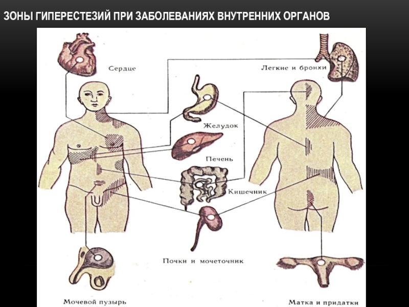 Заболевания внутренних органов. Инфекции внутренних органов. Поражения кожи при болезнях внутренних органов. Зоны гиперестезии при заболевании. Поражение кожи при заболеваниях внутренних органов.