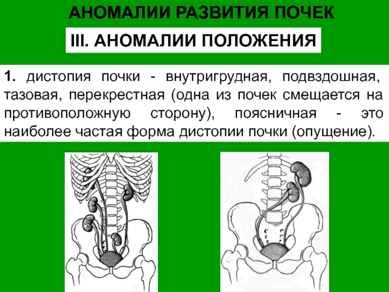 Нефроптоз дистопия. Аномалии развития почек дистопия. Перекрестная дистопия почки.