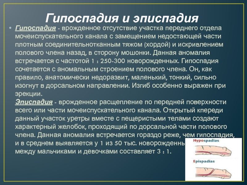 Аномалии развития мочеиспускательного канала презентация