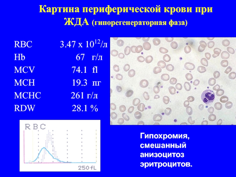 Для железодефицитной анемии характерна такая картина периферической крови