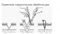 Первичная хирургическая обработка ран