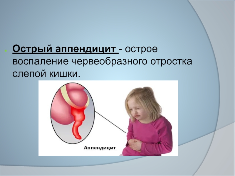 Острый аппендицит картинки для презентации