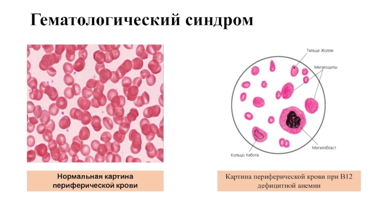 Картина крови при анемии