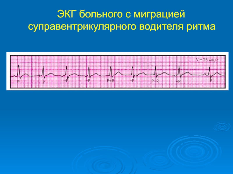 Нарушение ритма у детей презентация