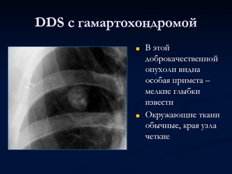 DDS с гамартохондромойВ этой доброкачественной опухоли видна особая примета – мелкие глыбки известиОкружающие ткани обычные, края узла