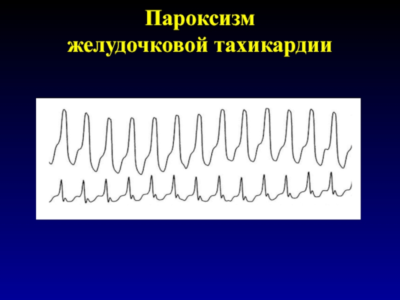 Желудочковая тахикардия. Пароксизмальная тахикардия желудочков. Пароксизмальная желудочковая тахикардия. Пароксизмальная желудочковая аритмия. Пароксизм желудочковой тахикардии.