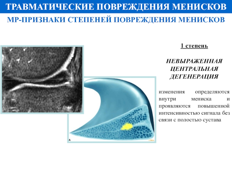 Мр картина повреждения внутреннего мениска 3а степени по stoller