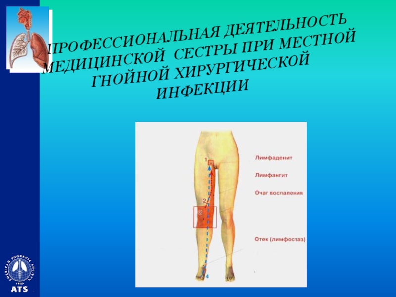 ПРОФЕССИОНАЛЬНАЯ ДЕЯТЕЛЬНОСТЬ МЕДИЦИНСКОЙ СЕСТРЫ ПРИ МЕСТНОЙ ГНОЙНОЙ