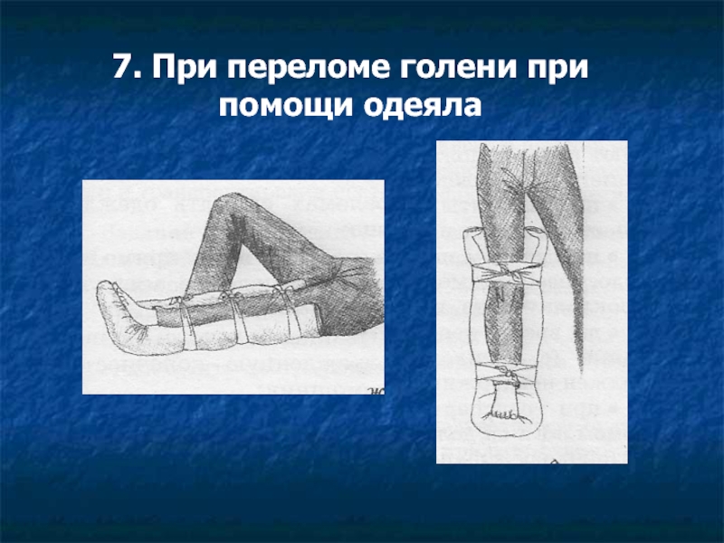 Переломы голени презентация