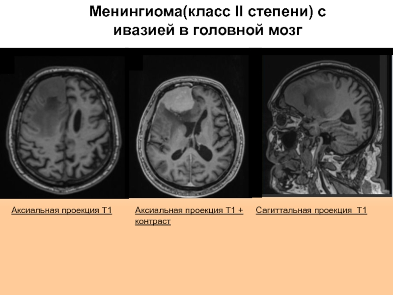 Рак мозга степени. Опухоль головного мозга менингиома. Петрифицированная менингиома. Менингиома доброкачественная.